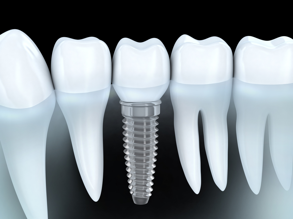 an image of a row of teeth, the tooth in the middle is a dental implant