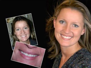Smile Makeover Gallery