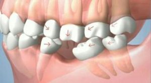 Implants and Tooth Replacements