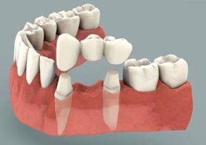 Implants and Tooth Replacements